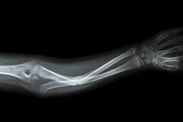 Broken Arm Treatments - Fair Oaks Orthopedics Fairfax VA