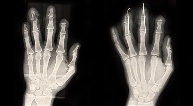 Hand Fixation Surgery