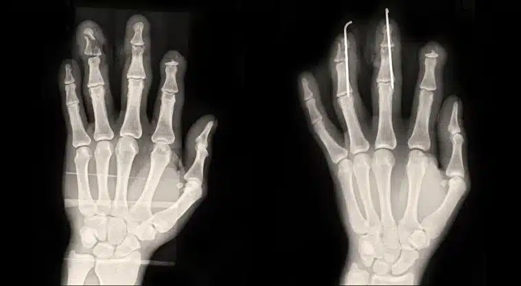 Hand Fixation Surgery