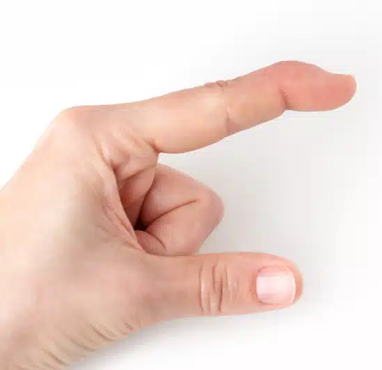 Mallet Finger - Baseball Injuries - Sports Medicine Othopedics Fairfax VA