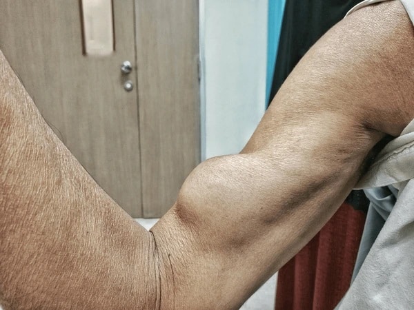 Biceps Tendon Tears of the Elbow & Shoulder - Fairfax, VA