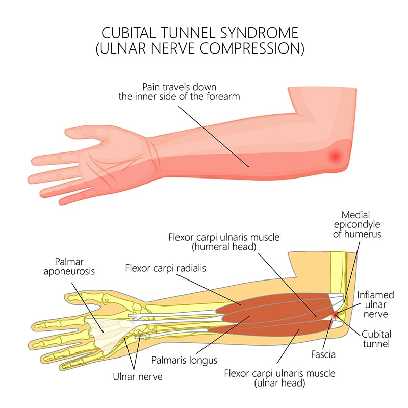 Cubital Tunnel Syndrome Specialists Fairfax VA