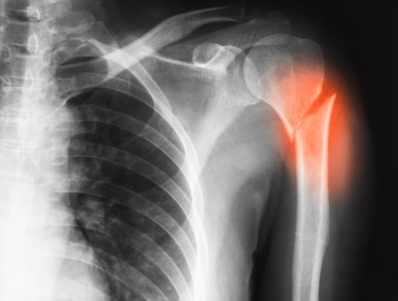 proximal humerus fracture - broken upper arm